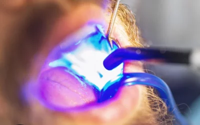 Composite Fillings vs. Silver Fillings: What’s Best for You in Fairhope, AL?